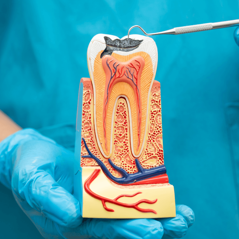 Root Canal Therapy in Ahmedabad
