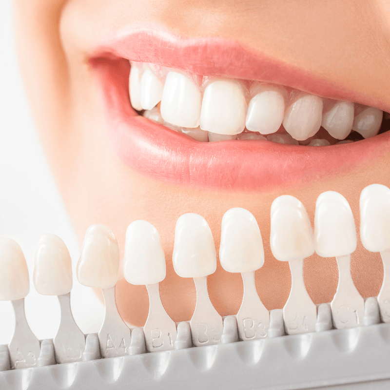 Professional Teeth Whitening in Ahmedabad