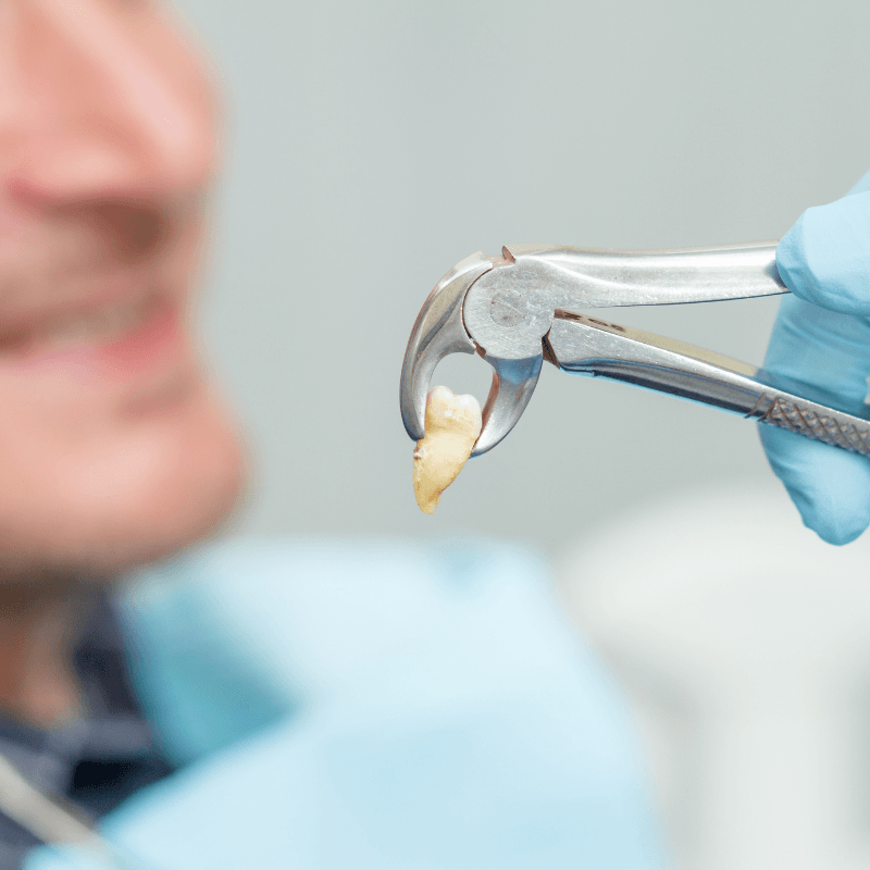 Tooth Extractions in Ahmedabad